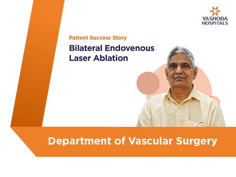Bilateral Endovenous Laser Ablation