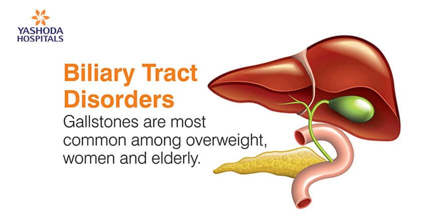 Biliary Tract Disorders: Gallstones