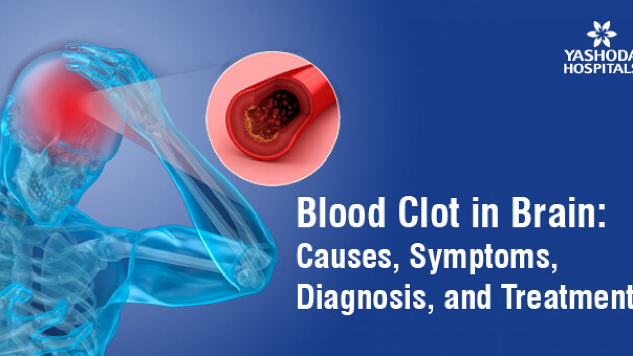 Exercises to Help Prevent Blood Clots