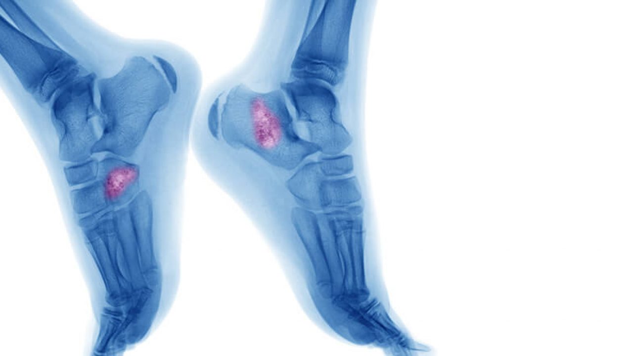 Recognizing the Signs of Ankle Bone Cancer: Symptoms to Watch For