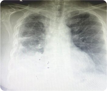 Bullous Lung Disease with Spontaneous Right Sided Pneumothorax
