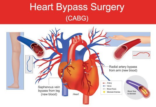 Coronary Artery Bypass Grafting (CABG) at Affordable Cost in Hyderabad