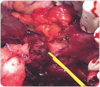Extended Cholecystectomy with CBD Excision for Squamous Cell Carcinoma of Gall Bladder