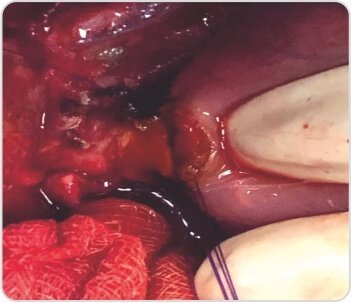 Extended Cholecystectomy with CBD Excision for Squamous Cell Carcinoma of Gall Bladder