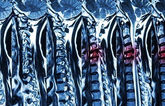 WHAT IS CERVICAL SPINE SURGERY