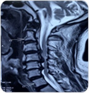 Pre-op MRI showing significant cord compression