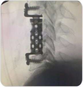 C-arm image showing implant