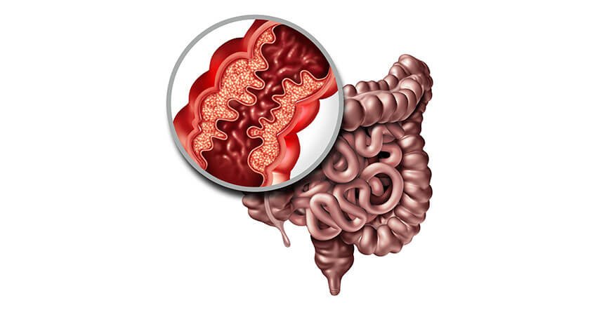 Crohn’s disease or inflammatory bowel disease