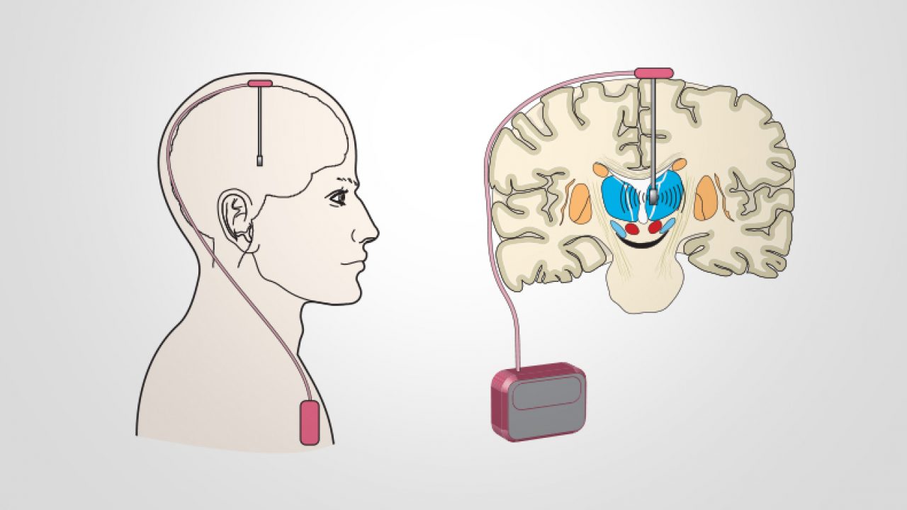 Deep-Brain Stimulation for Parkinson's Disease