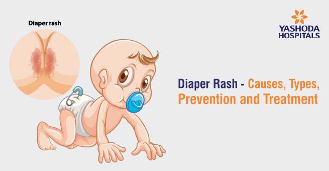 Diaper rash causes treatment