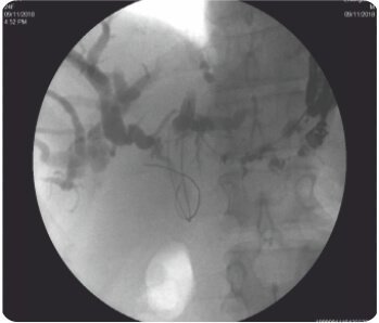 Endoscopic Ultrasound Guided Hepatico - Gastrostomy