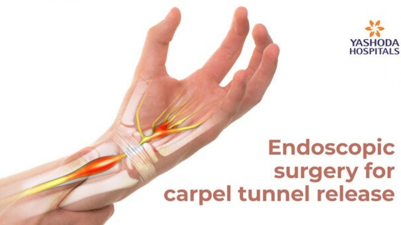 Endoscopic Carpal Tunnel Surgery for Carpal Tunnel Syndrome