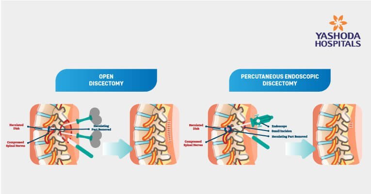 Endoscopic or minimally invasive spine surgery