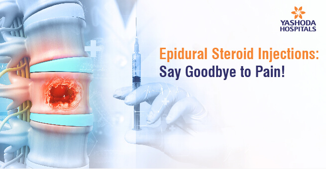 Epidural Steroid Injections: Say Goodbye to Pain!