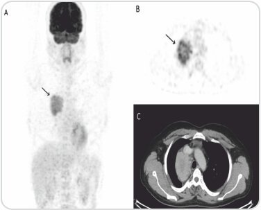 FDG PETCT in Isolated Mediastinal IgG4