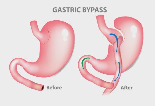 Gastric Bypass Surgery Cost in Hyderabad, India