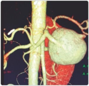 Giant Splenic Artery Aneurysm Treated by (spleen Sparing) Endovascular Embolization
