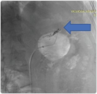 Giant Splenic Artery Aneurysm Treated by (spleen Sparing) Endovascular Embolization