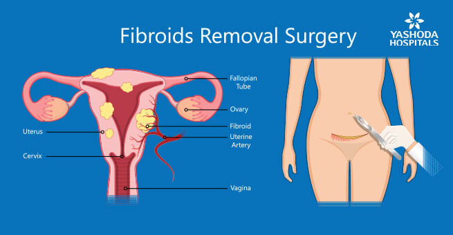 Have surgery for all fibroids