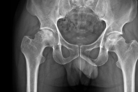 Osteonecrosis Hip Joint