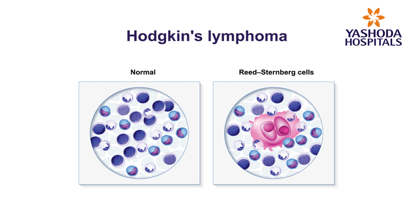 Hodgkin’s lymphoma Hodgkin’s lymphoma