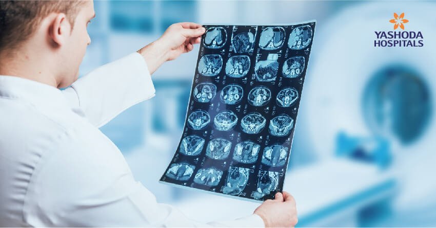 How do doctors diagnose glioma