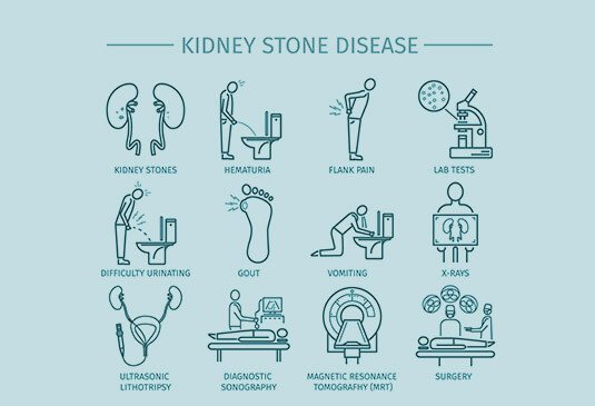 Kidney stone removal surgery cost in Hyderabad