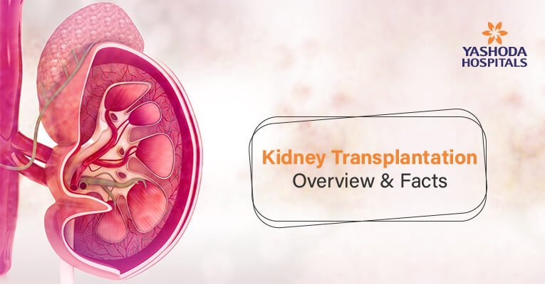 Kidney transplant FAQs