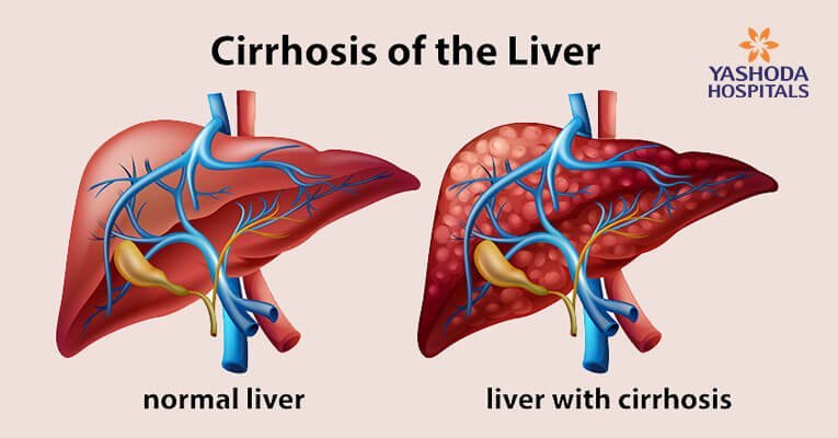 Liver Transplantation Current Status and Challenges