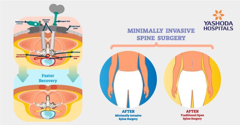 Minimally-Invasive Spine Surgery (MISS)