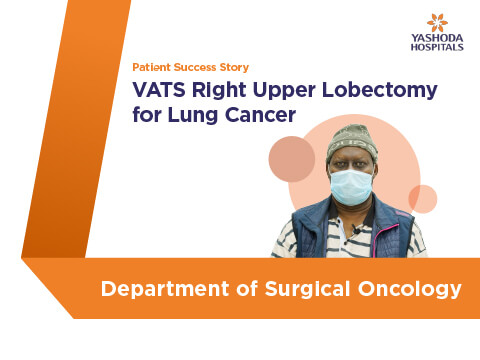 VATS Right Upper Lobectomy for Lung Cancer