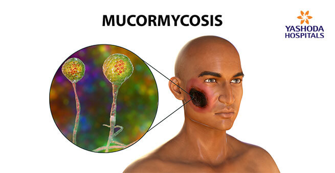 Mucormycosis