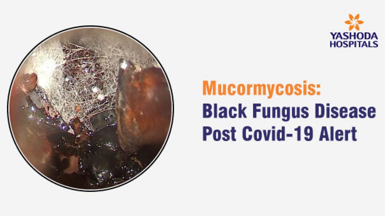 Mucormycosis Black Fungus Disease Post Covid 19