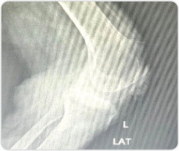 Distal Femoral Replacement for Severe Osteoarthritis Knee With Osteoporotic Distal Femoral Fracture