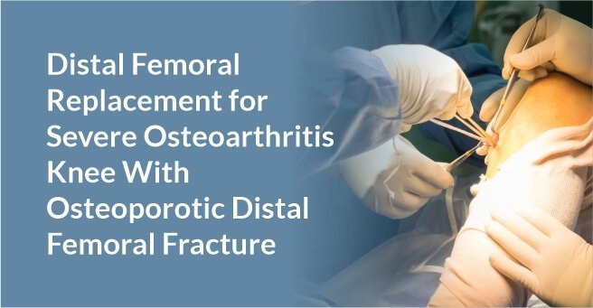 Distal Femoral Replacement for Severe Osteoarthritis Knee With Osteoporotic Distal Femoral Fracture