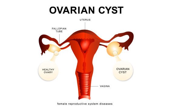 Ovarian Cyst Removal Cost in India | Ovarian Cyst Removal Cost in Hyderabad