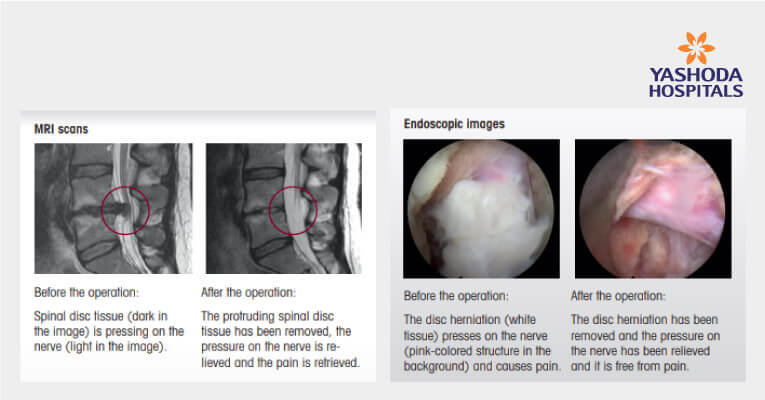 PELD (Percutaneous Endoscopic Lumbar Discectomy)
