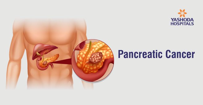 Best pancreatic cancer treatment