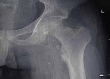 Preop X-Ray