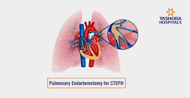 Pulmonary Endarterectomy