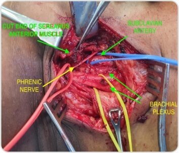 Right Arterial TOS (Thoracic Outlet Syndrome) Decompression by Cervical Rib Excision for Acute Upper Limb Ischemia