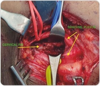 Right Arterial TOS (Thoracic Outlet Syndrome) Decompression by Cervical Rib Excision for Acute Upper Limb Ischemia