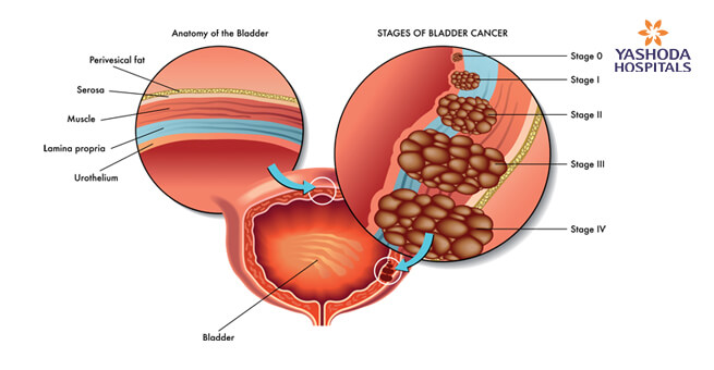 Risk factors for bladder cancer