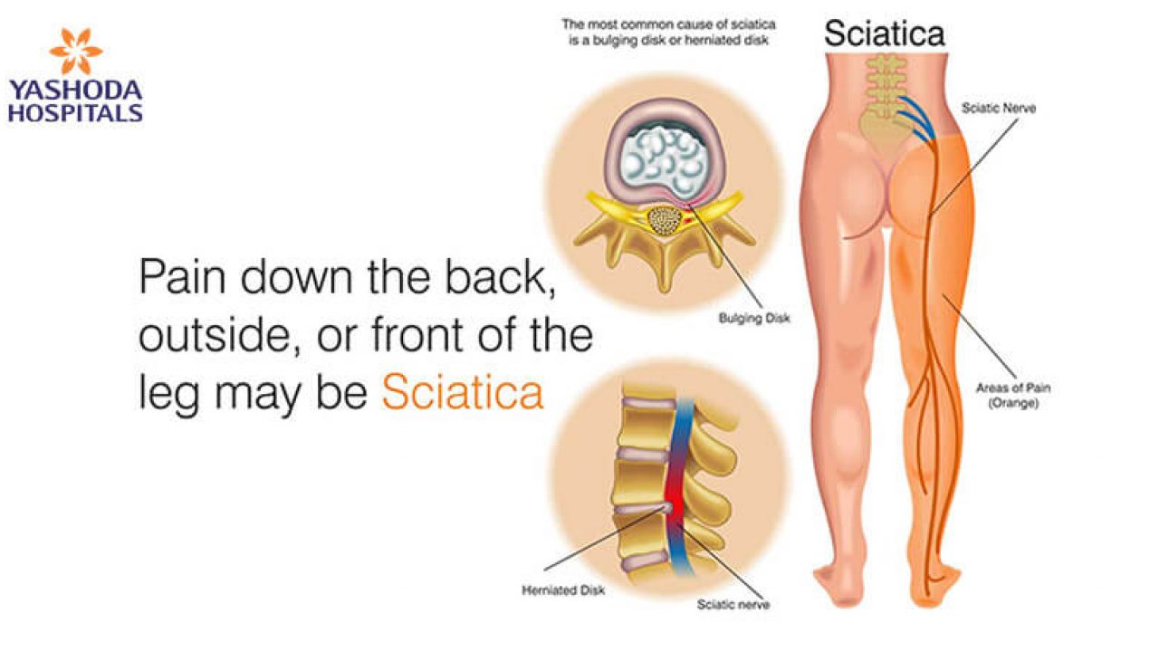How to treat Sciatica or Sciatic Nerve Pain