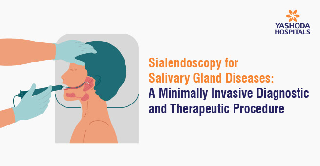 Sialendoscopy for Salivary Gland Diseases - Yashoda Hospitals