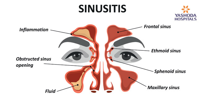 Sinusities symptoms