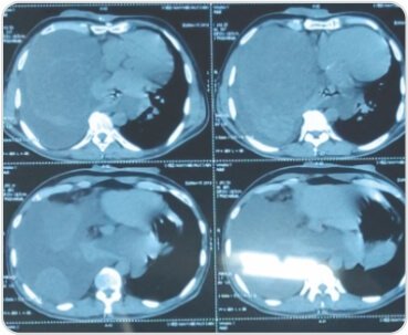 Video-Assisted Thoracoscopic Surgery of Solitary Fibrous Pleural Tumor