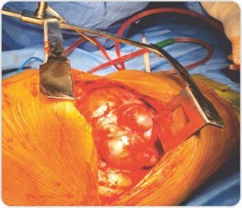 Video-Assisted Thoracoscopic Surgery of Solitary Fibrous Pleural Tumor