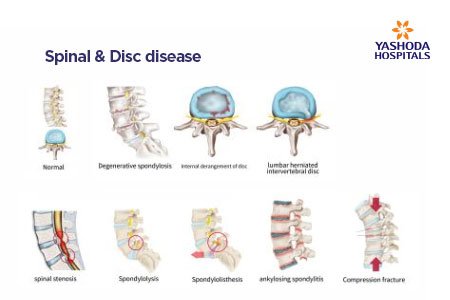 Spondylolysis and Spondylolisthesis What are the Symptoms and Complications