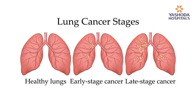 Stages in Lung Cancer